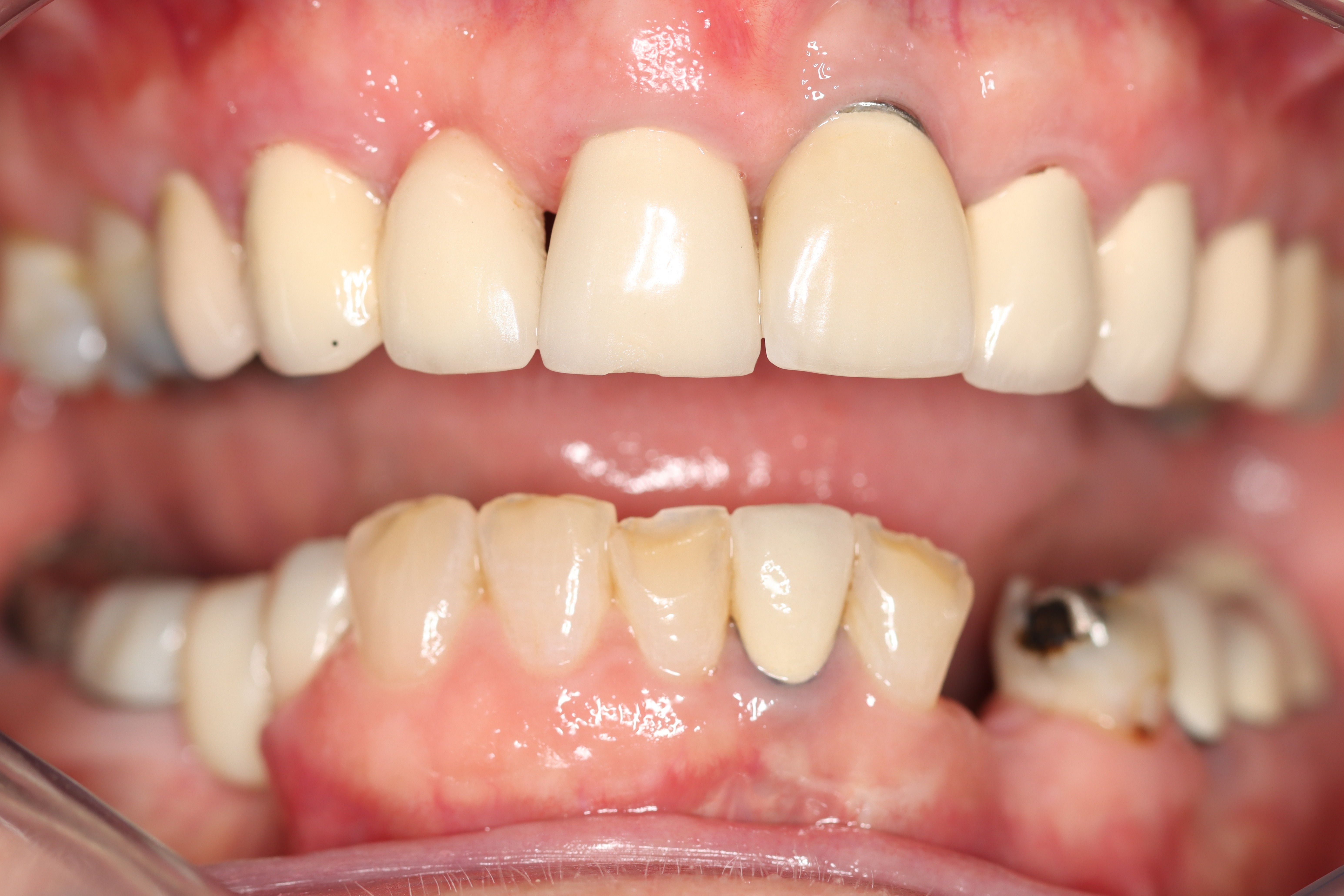 Full-mouth restoration with implant crown — before — Dr Chalita le Roux Inc., Amorosa Office Park Full-mouth restoration with anterior dental implant crown — before, Dr Chalita le Roux Inc., Roodepoort