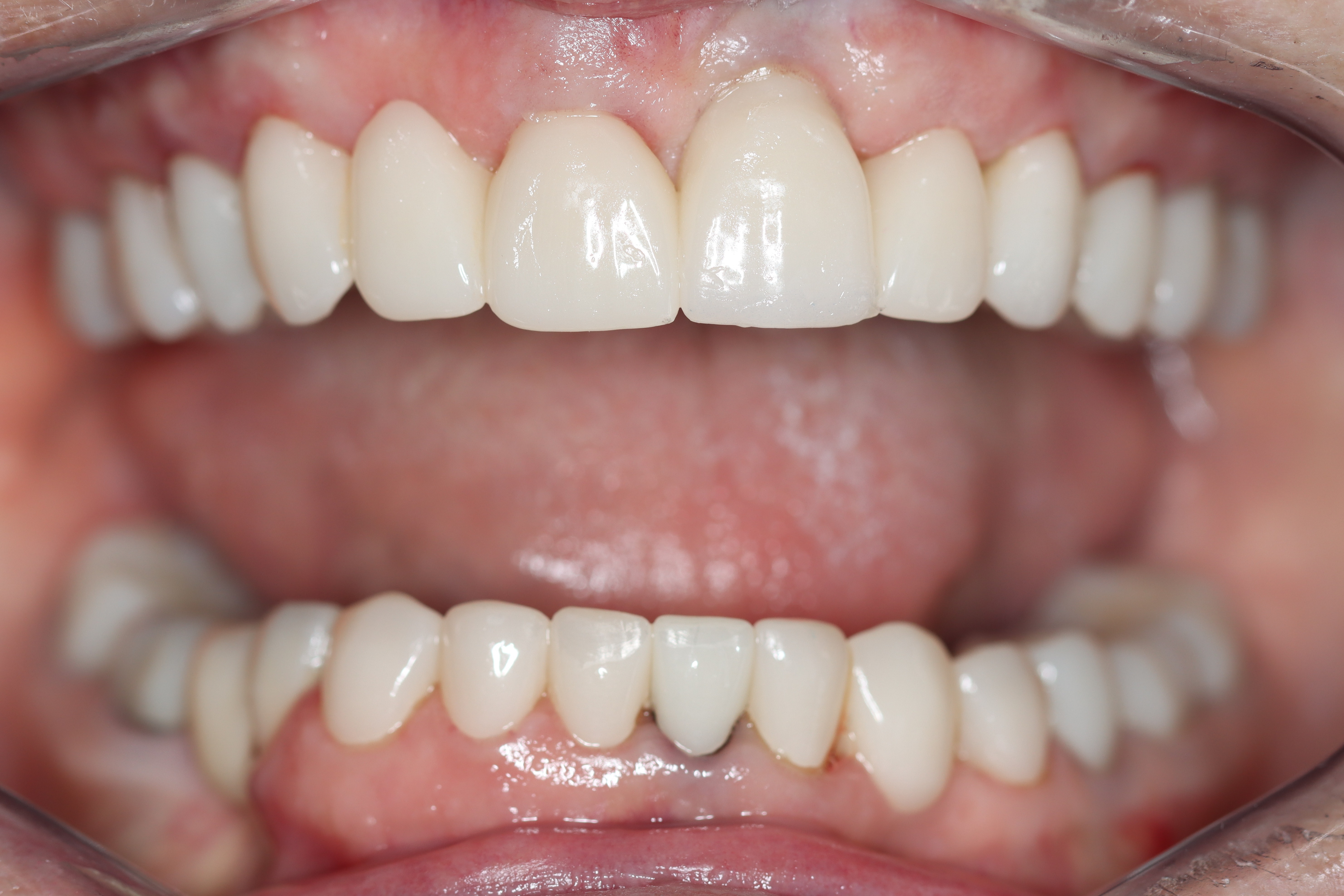 Anterior dental implant crown restoration — Dr Chalita le Roux Inc., Amorosa Office Park Anterior dental implant crown restoration — colour-matched ceramic outcome at Dr Chalita le Roux's Roodepoort practice