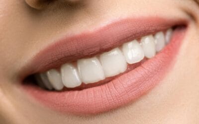 HOME 1 How Much Do Veneers Cost in South Africa – Roodepoort Dentist Guide