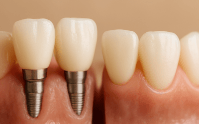 Dental Implants vs Bridges: Missing Tooth Options Explained | Dr Chalita le Roux