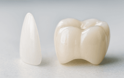 Veneers or Crowns: Which Lasts Longer?