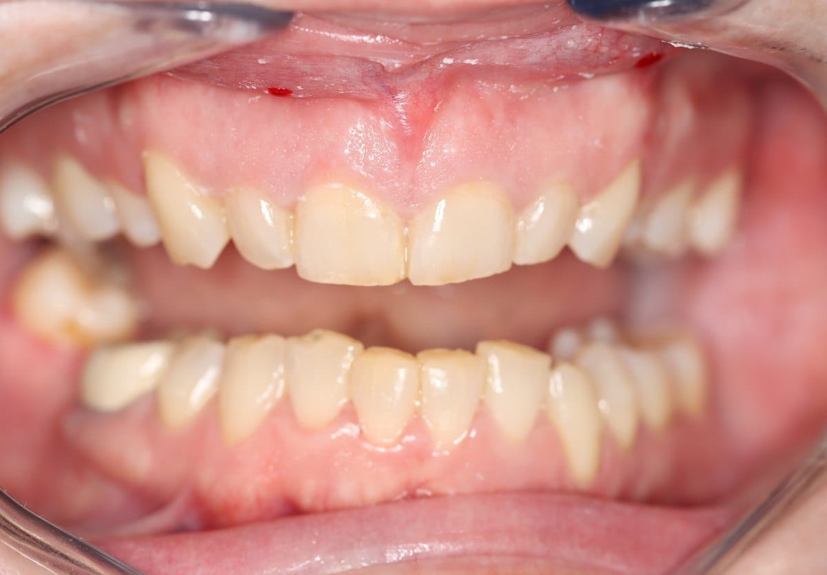 Close-up of upper front teeth before a gingivectomy, showing an uneven gum line covering the teeth unequally