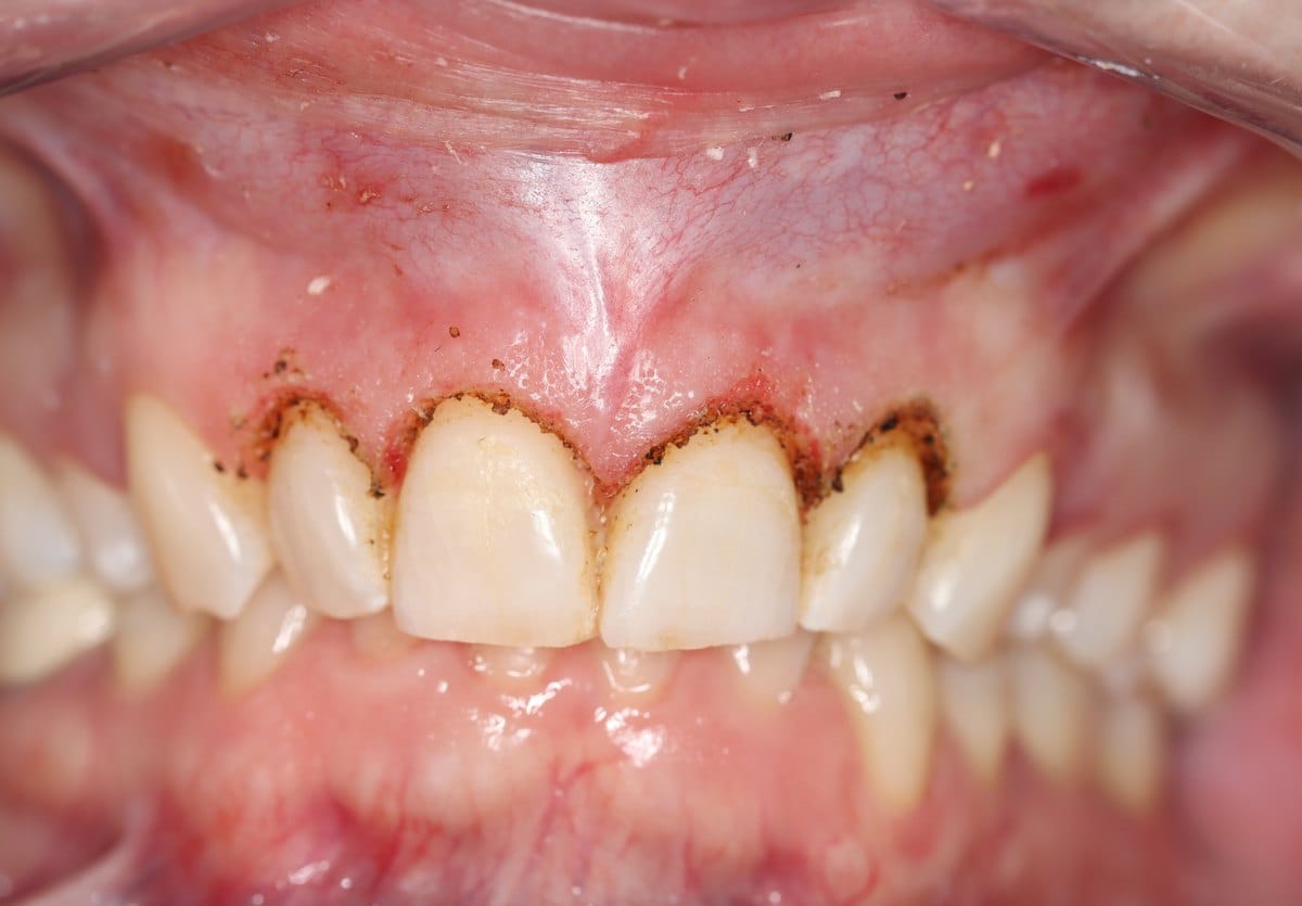 Upper front teeth immediately after a gingivectomy, showing the newly scalloped gum margin before healing