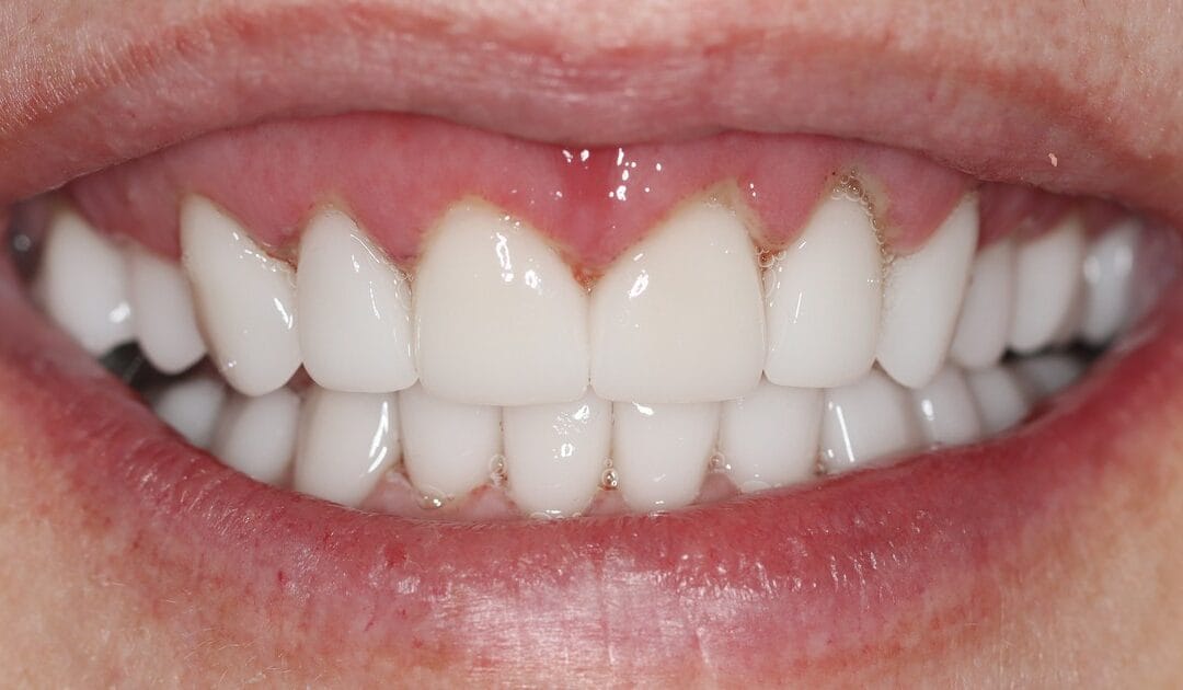 Completed smile makeover result in Roodepoort showing an even gum line and full ceramic crowns in a natural smile