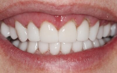 Gingivectomy Before Crowns: A Roodepoort Smile Makeover Case