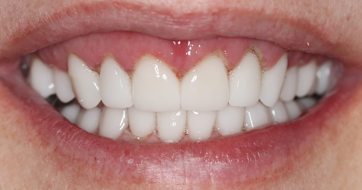 Completed smile makeover result in Roodepoort showing an even gum line and full ceramic crowns in a natural smile