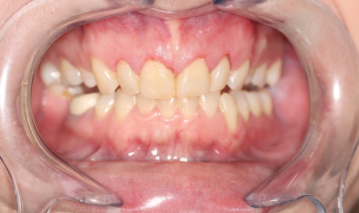 Retracted view before crown treatment showing worn, darkened teeth meeting edge to edge with a healed gum line