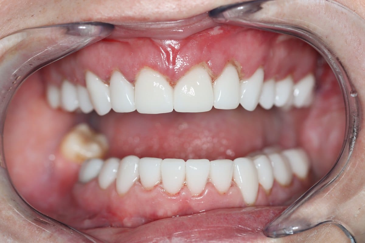 Both upper and lower arches restored with ceramic crowns at the completion of the smile makeover