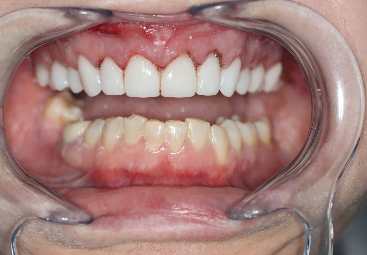 Upper arch restored with ceramic crowns while the lower natural teeth remain untreated, showing the contrast